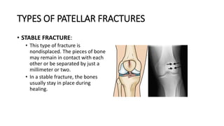 TYPES OF PATELLAR FRACTURES
• STABLE FRACTURE:
• This type of fracture is
nondisplaced. The pieces of bone
may remain in contact with each
other or be separated by just a
millimeter or two.
• In a stable fracture, the bones
usually stay in place during
healing.
 