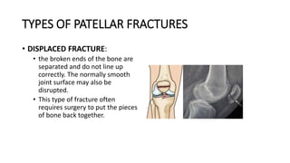 TYPES OF PATELLAR FRACTURES
• DISPLACED FRACTURE:
• the broken ends of the bone are
separated and do not line up
correctly. The normally smooth
joint surface may also be
disrupted.
• This type of fracture often
requires surgery to put the pieces
of bone back together.
 
