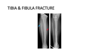 TIBIA & FIBULA FRACTURE
 