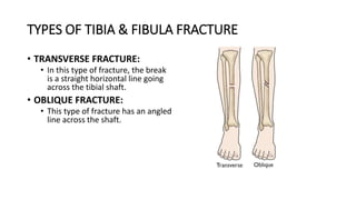TYPES OF TIBIA & FIBULA FRACTURE
• TRANSVERSE FRACTURE:
• In this type of fracture, the break
is a straight horizontal line going
across the tibial shaft.
• OBLIQUE FRACTURE:
• This type of fracture has an angled
line across the shaft.
 