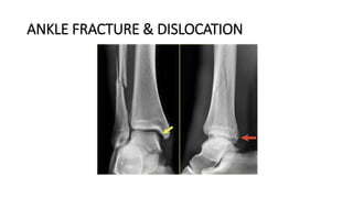 ANKLE FRACTURE & DISLOCATION
 