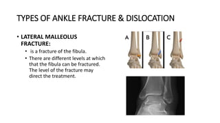 TYPES OF ANKLE FRACTURE & DISLOCATION
• LATERAL MALLEOLUS
FRACTURE:
• is a fracture of the fibula.
• There are different levels at which
that the fibula can be fractured.
The level of the fracture may
direct the treatment.
 