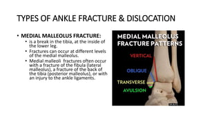 TYPES OF ANKLE FRACTURE & DISLOCATION
• MEDIAL MALLEOLUS FRACTURE:
• is a break in the tibia, at the inside of
the lower leg.
• Fractures can occur at different levels
of the medial malleolus.
• Medial malleoli fractures often occur
with a fracture of the fibula (lateral
malleolus), a fracture of the back of
the tibia (posterior malleolus), or with
an injury to the ankle ligaments.
 