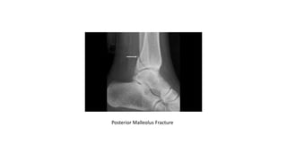 Posterior Malleolus Fracture
 