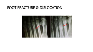 FOOT FRACTURE & DISLOCATION
 