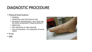 DIAGNOSTIC PROCEDURE
• Physical Examination:
• Swelling
• Tenderness over the fracture site
• Bruising or discoloration—your foot may
be red or ecchymotic ("black and blue")
• Deformity
• Skin abrasions or open wounds
• Loss of sensation—an indication of nerve
injury
• X-ray
• MRI
 