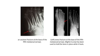 an avulsion fracture at the base of the
fifth metatarsal (arrow).
(Left) Jones fracture at the base of the fifth
metatarsal (arrow). (Right) A screw has been
used to hold the bone in place while it heals.
 