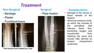 Treatment
Non-Surgical
- Bandage
- Plaster
- Functional brace
Surgical
- Plate fixation
This fracture was treated by a cast
Complications:
• Damage to the nerves or
blood vessels of the
forearm.
• Abnormal pressure build-
up within the muscles of
the arm/elbow that
reduces blood flow,
preventing oxygen and
nourishment from
reaching the nerve and
muscle cells (termed as
forearm compartment
syndrome)
 