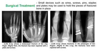 Surgical Treatment
- Small devices such as wires, screws, pins, staples
and plates may be used to hold the pieces of fractured
bone in place
- (Left) X-ray shows a metacarpal fracture of the ring
finger. (Right) Here, the fracture has been repaired with a
plate and screws.
- (Left) X-ray shows fractures in the phalanges of two
fingers. (Right) In this x-ray, the fractures have been
repaired with screws.
 