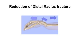 Reduction of Distal Radius fracture
 