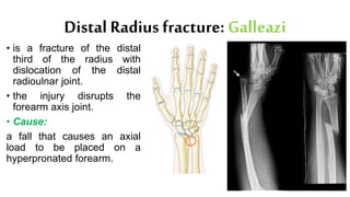 Distal Radius fracture: Galleazi
• is a fracture of the distal
third of the radius with
dislocation of the distal
radioulnar joint.
• the injury disrupts the
forearm axis joint.
• Cause:
a fall that causes an axial
load to be placed on a
hyperpronated forearm.
 