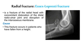 Radial fracture: Essex-Lopresti fracture
• is a fracture of the radial head with
concomitant dislocation of the distal
radio-ulnar joint and disruption of
the interosseous membrane.
Cause
• This fracture occurs in patients who
have fallen from a height.
 