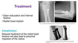 Treatment
• Open reducation and internal
fixation
• Radial head implant
Complication:
Delayed treatment of the radial head
fracture will also lead to proximal
migration of the radius
 
