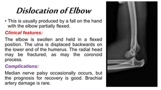 DislocationofElbow
• This is usually produced by a fall on the hand
with the elbow partially flexed.
Clinical features:
The elbow is swollen and held in a flexed
position. The ulna is displaced backwards on
the lower end of the humerus. The radial head
may be fractured, as may the coronoid
process.
Complications:
Median nerve palsy occasionally occurs, but
the prognosis for recovery is good. Brachial
artery damage is rare.
 
