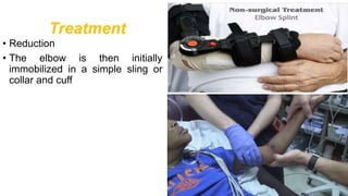 Treatment
• Reduction
• The elbow is then initially
immobilized in a simple sling or
collar and cuff
 