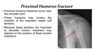 ProximalHumerusfracture
• Proximal humerus fractures occur near
the shoulder joint.
• These fractures may involve the
insertion of the important rotator cuff
tendons.
• Because these tendons are important
to shoulder motion, treatment may
depend on the position of these tendon
insertions.
 