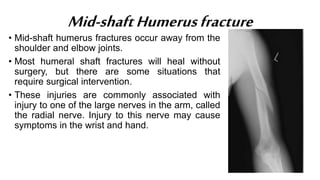 Mid-shaftHumerusfracture
• Mid-shaft humerus fractures occur away from the
shoulder and elbow joints.
• Most humeral shaft fractures will heal without
surgery, but there are some situations that
require surgical intervention.
• These injuries are commonly associated with
injury to one of the large nerves in the arm, called
the radial nerve. Injury to this nerve may cause
symptoms in the wrist and hand.
 