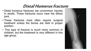 DistalHumerusfracture
• Distal humerus fractures are uncommon injuries
in adults. These fractures occur near the elbow
joint.
• These fractures most often require surgical
treatment unless the bones are held in proper
position.
• This type of fracture is much more common in
children, but the treatment is very different in this
age group.
 