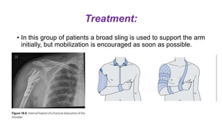 Treatment:
• In this group of patients a broad sling is used to support the arm
initially, but mobilization is encouraged as soon as possible.
 