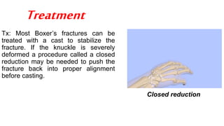 Treatment
Tx: Most Boxer’s fractures can be
treated with a cast to stabilize the
fracture. If the knuckle is severely
deformed a procedure called a closed
reduction may be needed to push the
fracture back into proper alignment
before casting.
Closed reduction
 
