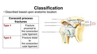 Classification
• Described based upon anatomic location
Coracoid process
fractures
Type 1 Fracture
proximal to
the coracoclavi
cular ligament
Type 2 Fracture distal
to
the coracoclavi
cular ligament
 