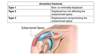 Acromion fractures
Type 1 Non- or minimally-displaced
Type 2 Displaced but not affecting the
subacromial space
Type 3 Displacement compromising the
subacromial space
 