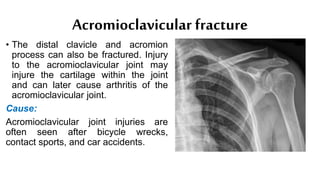 Acromioclavicular fracture
• The distal clavicle and acromion
process can also be fractured. Injury
to the acromioclavicular joint may
injure the cartilage within the joint
and can later cause arthritis of the
acromioclavicular joint.
Cause:
Acromioclavicular joint injuries are
often seen after bicycle wrecks,
contact sports, and car accidents.
 