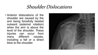 ShoulderDislocations
• Anterior dislocations of the
shoulder are caused by the
arm being forcefully twisted
outward (external rotation)
when the arm is above the
level of the shoulder. These
injuries can occur from
many different causes,
including a fall or a direct
blow to the shoulder.
 