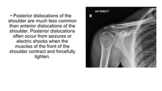 • Posterior dislocations of the
shoulder are much less common
than anterior dislocations of the
shoulder. Posterior dislocations
often occur from seizures or
electric shocks when the
muscles of the front of the
shoulder contract and forcefully
tighten.
 