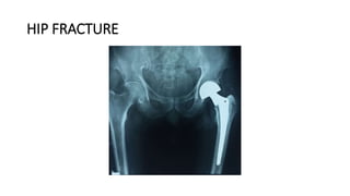 HIP FRACTURE
 