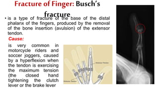 Fracture of Finger: Busch’s
fracture• is a type of fracture of the base of the distal
phalanx of the fingers, produced by the removal
of the bone insertion (avulsion) of the extensor
tendon.
Cause:
is very common in
motorcycle riders and
soccer joggers, caused
by a hyperflexion when
the tendon is exercising
the maximum tension
(the closed hand
tightening the clutch
lever or the brake lever
 