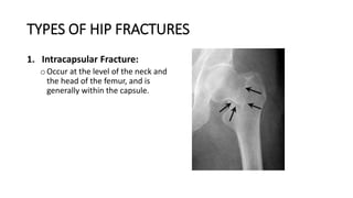 TYPES OF HIP FRACTURES
1. Intracapsular Fracture:
oOccur at the level of the neck and
the head of the femur, and is
generally within the capsule.
 