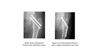 Repair of an intracapsular
fracture with individual screws.
Repair of an intercapsular fracture
with a single compression hip screw
 
