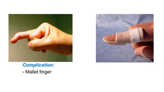 Complication:
- Mallet finger
 