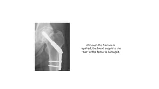 Although the fracture is
repaired, the blood supply to the
"ball" of the femur is damaged.
 