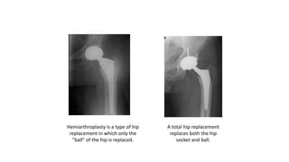 Hemiarthroplasty is a type of hip
replacement in which only the
"ball" of the hip is replaced.
A total hip replacement
replaces both the hip
socket and ball.
 