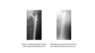 Repair of subtrochanteric fracture
with a long intramedullary nail.
Interlocking screws at the end of the
nail make the fixation more secure.
 