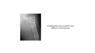 A locking plate may be used for more
difficult to treat fractures.
 