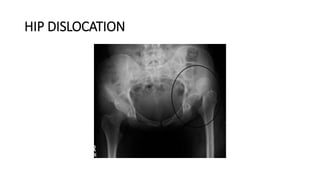 HIP DISLOCATION
 