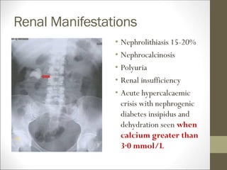 Renal Manifestations
• Nephrolithiasis 15-20%
• Nephrocalcinosis
• Polyuria
• Renal insufficiency
• Acute hypercalcaemic
crisis with nephrogenic
diabetes insipidus and
dehydration seen when
calcium greater than
3·0 mmol/L
 
