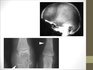 subperiosteal resorption
 