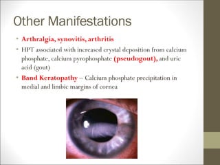 Other Manifestations
• Arthralgia, synovitis, arthritis
• HPT associated with increased crystal deposition from calcium
phosphate, calcium pyrophosphate (pseudogout), and uric
acid (gout)
• Band Keratopathy – Calcium phosphate precipitation in
medial and limbic margins of cornea
 