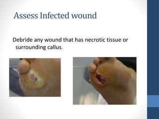 Debride any wound that has necrotic tissue or
surrounding callus.
Assess Infected wound
 