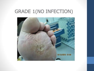 No symptoms or signs of infection
GRADE 1(NO INFECTION)
 