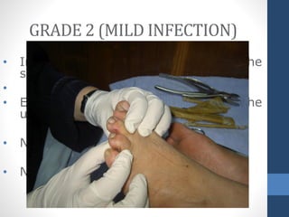 • Infection involving the skin and the
subcutaneous tissue only
•
• Erythema > 0.5 - 2 cm around the
ulcer.
• NO involvement of deeper tissues
• NO systemic signs.
GRADE 2 (MILD INFECTION)
 