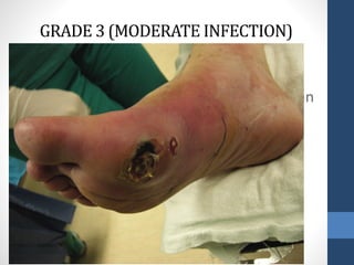 Infection involving structures deeper than
skin and subcutaneous tissues such as
abscess, osteomyelitis,
septic arthritis, fasciitis.
Erythema > 2 cm
No systemic inflammatory response
signs.
GRADE 3 (MODERATE INFECTION)
 