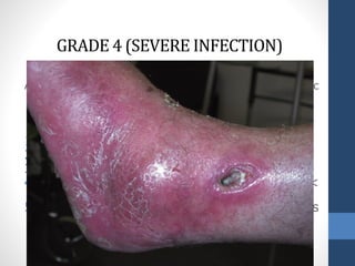 Any foot infection with signs of a systemic
inflammatory response syndrome (SIRS)
2 or more of the following :
1. Temperature > 38 or < 36°Celsius
2. Heart rate > 90 beats/min
3. Respiratory rate > 20 breaths/min
4. White blood cell count > 12.000 or <
4.000/cu mm
5. 10% immature (band) forms
GRADE 4 (SEVERE INFECTION)
 