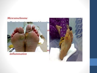 Mercurochrome
Topical antiseptic used for minor cuts
and scrapes.
No longer sold in the USA Mercury
content.
FDA ineffective, no longer
approved.
Dark red colour stains the skin
difficult detection of erythema or
inflammation
 