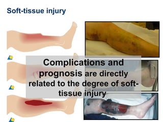 Soft-tissue injury
Complications and
prognosis are directly
related to the degree of soft-
tissue injury
 