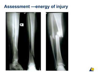 Assessment —energy of injury
 